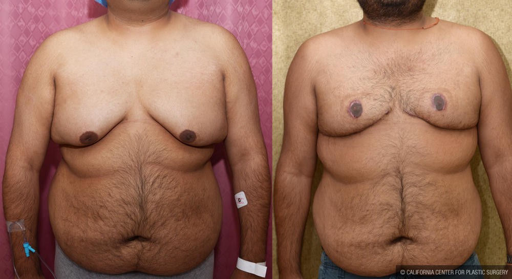 Male gynecomastia (breast) reduction Before & After Patient #12974