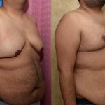 Male gynecomastia (breast) reduction Before & After Patient #12974