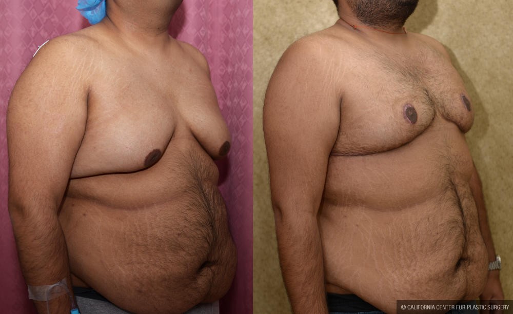 Male gynecomastia (breast) reduction Before & After Patient #12974