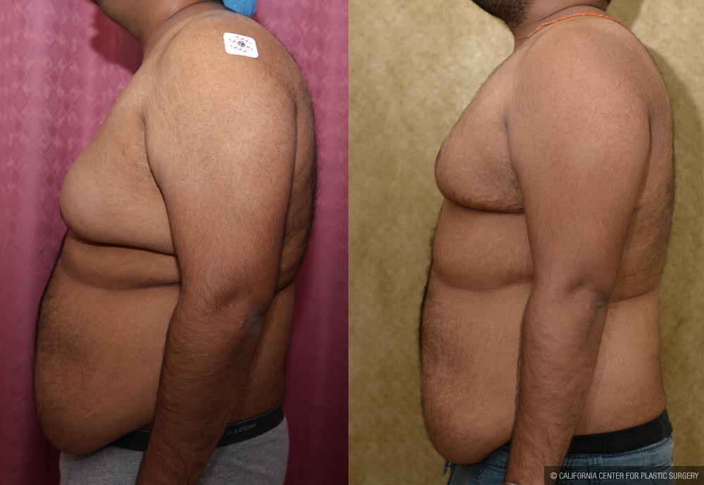 Male gynecomastia (breast) reduction Before & After Patient #12974