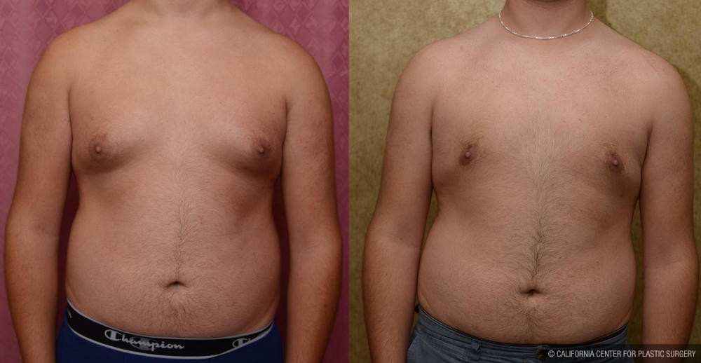 Male gynecomastia (breast) reduction Before & After Patient #12975