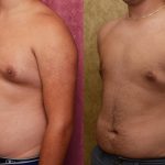 Male gynecomastia (breast) reduction Before & After Patient #12975