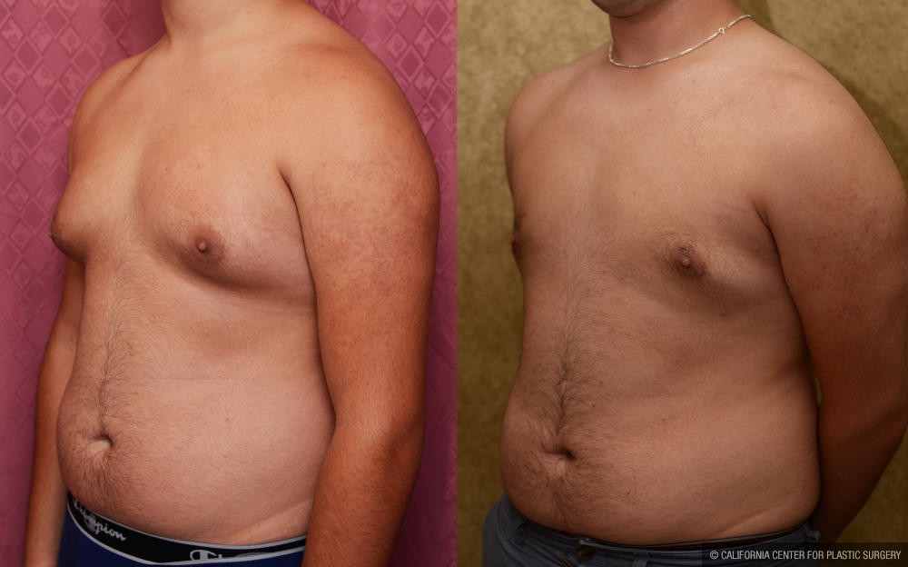 Male gynecomastia (breast) reduction Before & After Patient #12975