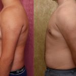 Male gynecomastia (breast) reduction Before & After Patient #12975