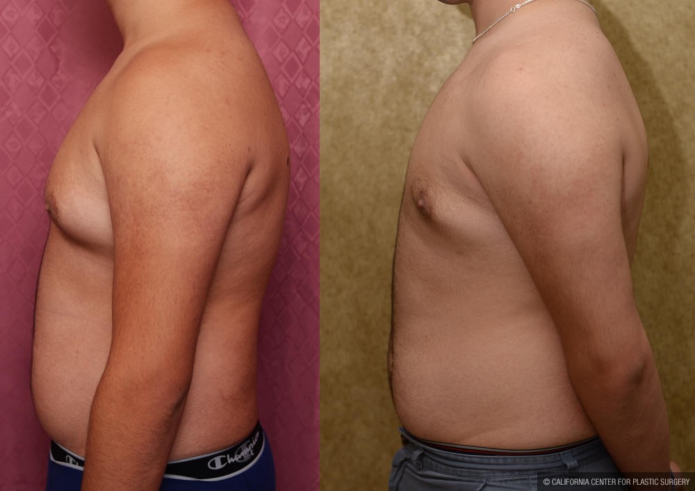 Male gynecomastia (breast) reduction Before & After Patient #12975