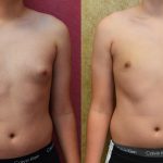 Male gynecomastia (breast) reduction Before & After Patient #12976