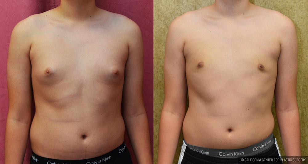 Male gynecomastia (breast) reduction Before & After Patient #12976