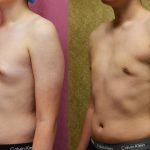 Male gynecomastia (breast) reduction Before & After Patient #12976