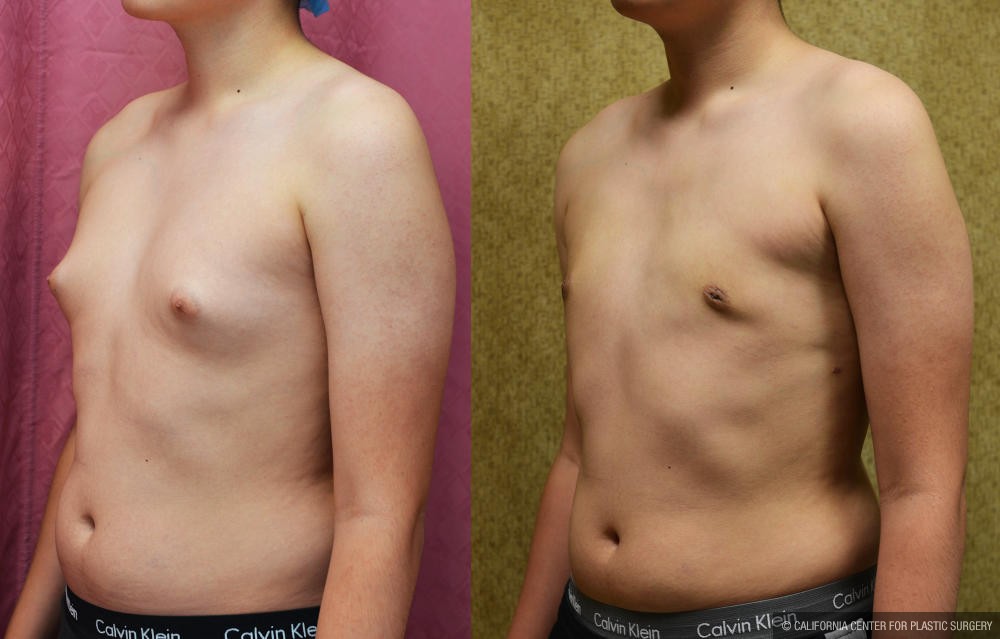 Male gynecomastia (breast) reduction Before & After Patient #12976