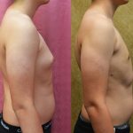 Male gynecomastia (breast) reduction Before & After Patient #12976