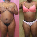 African American Tummy Tuck (Abdominoplasty) Before & After Patient #13013