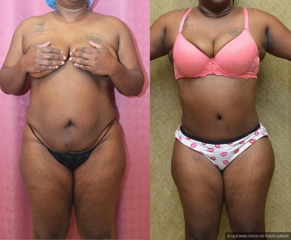 African American Tummy Tuck (Abdominoplasty) Before & After Patient #13013