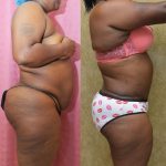 African American Tummy Tuck (Abdominoplasty) Before & After Patient #13013