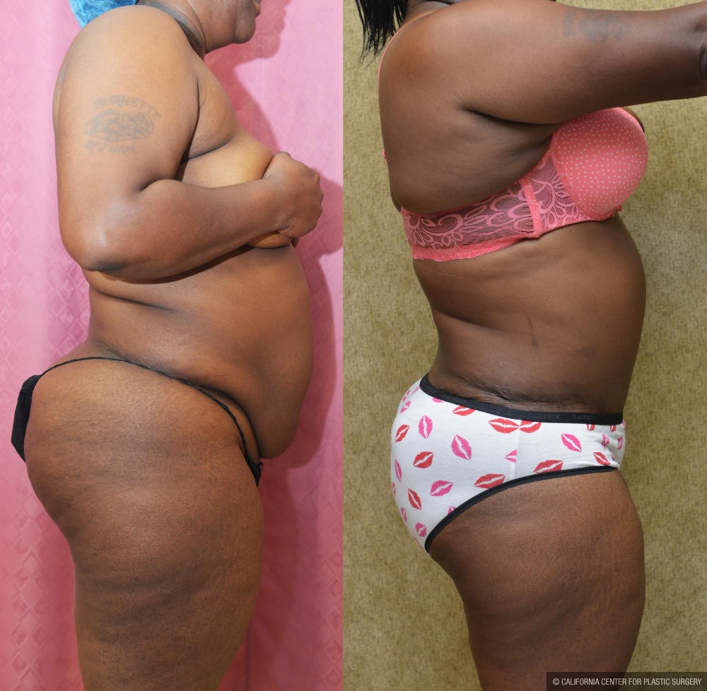 African American Tummy Tuck (Abdominoplasty) Before & After Patient #13013