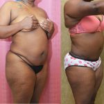 African American Tummy Tuck (Abdominoplasty) Before & After Patient #13013