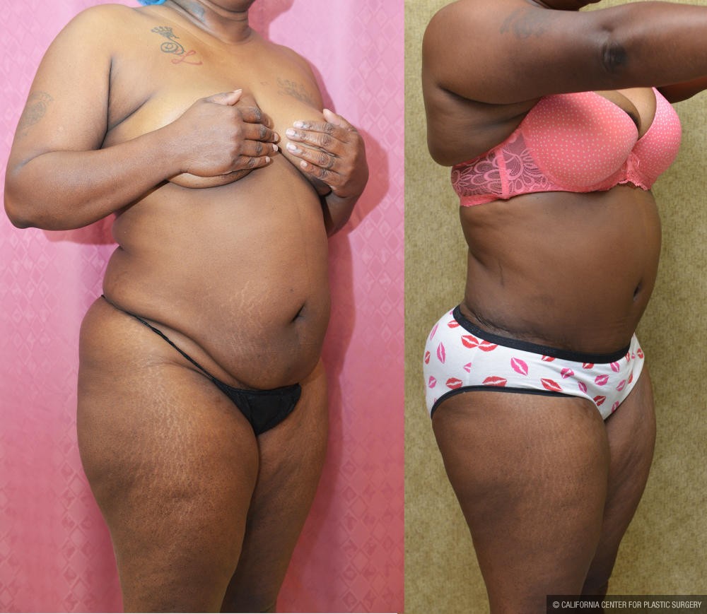 African American Tummy Tuck (Abdominoplasty) Before & After Patient #13013