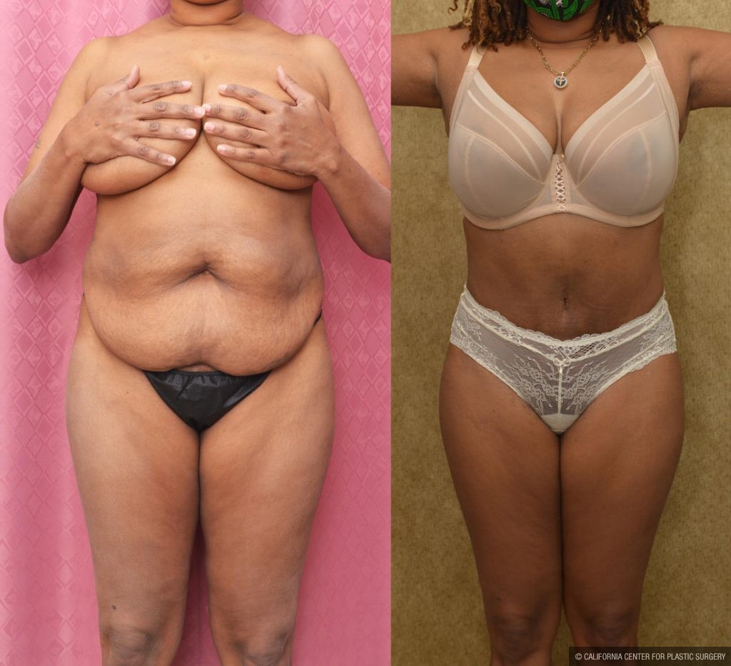 Tummy Tuck (Abdominoplasty) Small Size Before & After Patient #13073