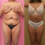 Tummy Tuck (Abdominoplasty) Small Size Before & After Patient #13073