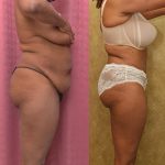 Tummy Tuck (Abdominoplasty) Small Size Before & After Patient #13073