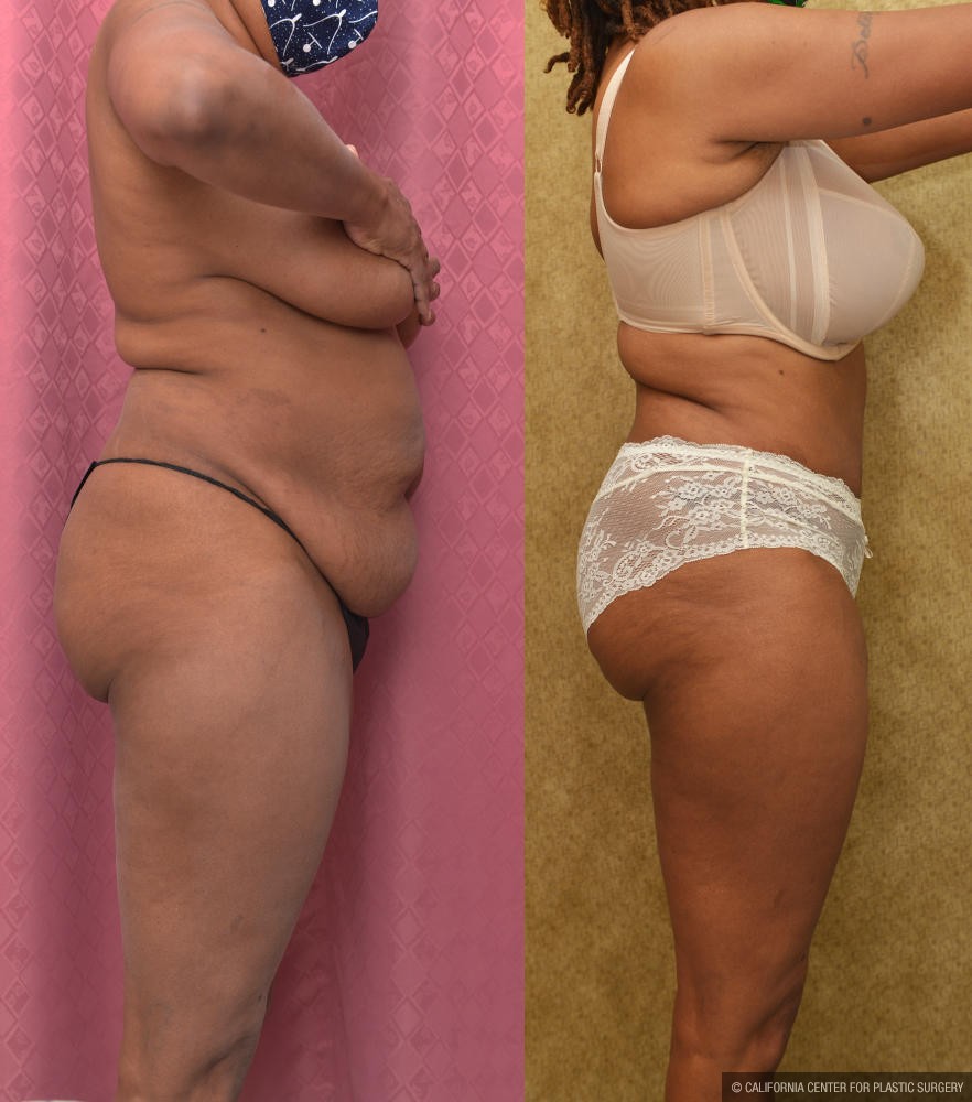 Tummy Tuck (Abdominoplasty) Small Size Before & After Patient #13073