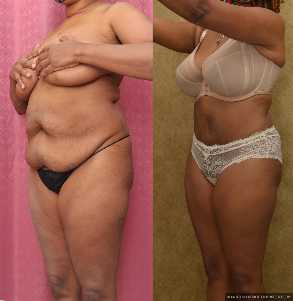 Tummy Tuck (Abdominoplasty) Small Size Before & After Patient #13073