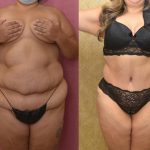 Tummy Tuck (Abdominoplasty) Plus Size Before & After Patient #13069