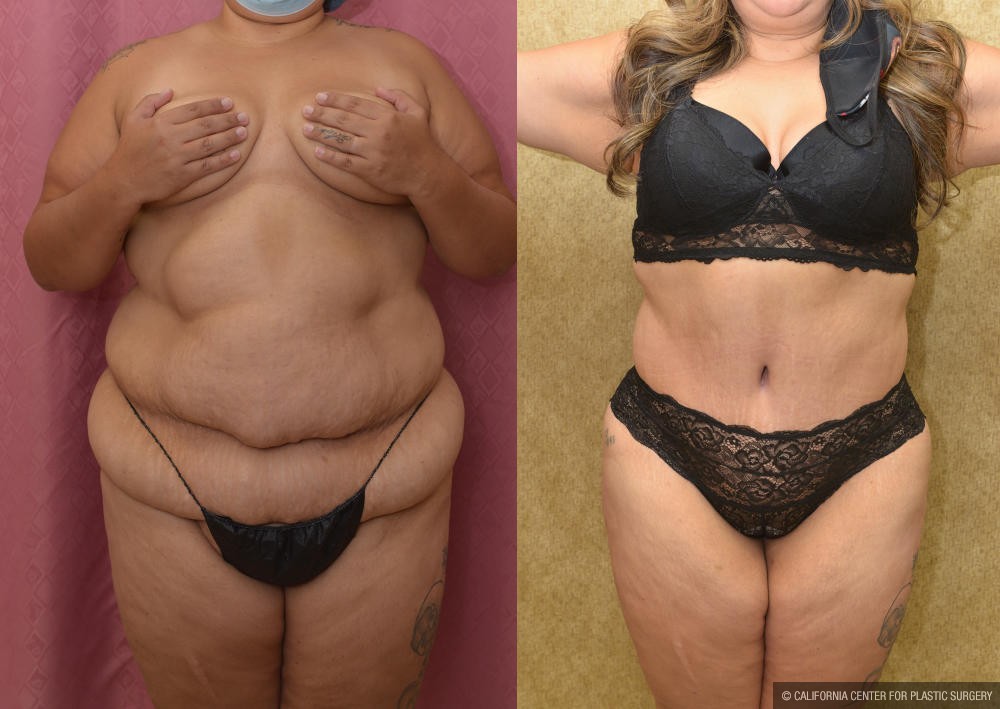 Tummy Tuck (Abdominoplasty) Plus Size Before & After Patient #13069