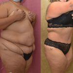 Tummy Tuck (Abdominoplasty) Plus Size Before & After Patient #13069