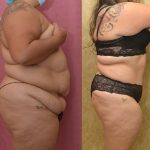Tummy Tuck (Abdominoplasty) Plus Size Before & After Patient #13069