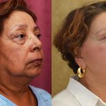 Facelift Before & After Patient #13101