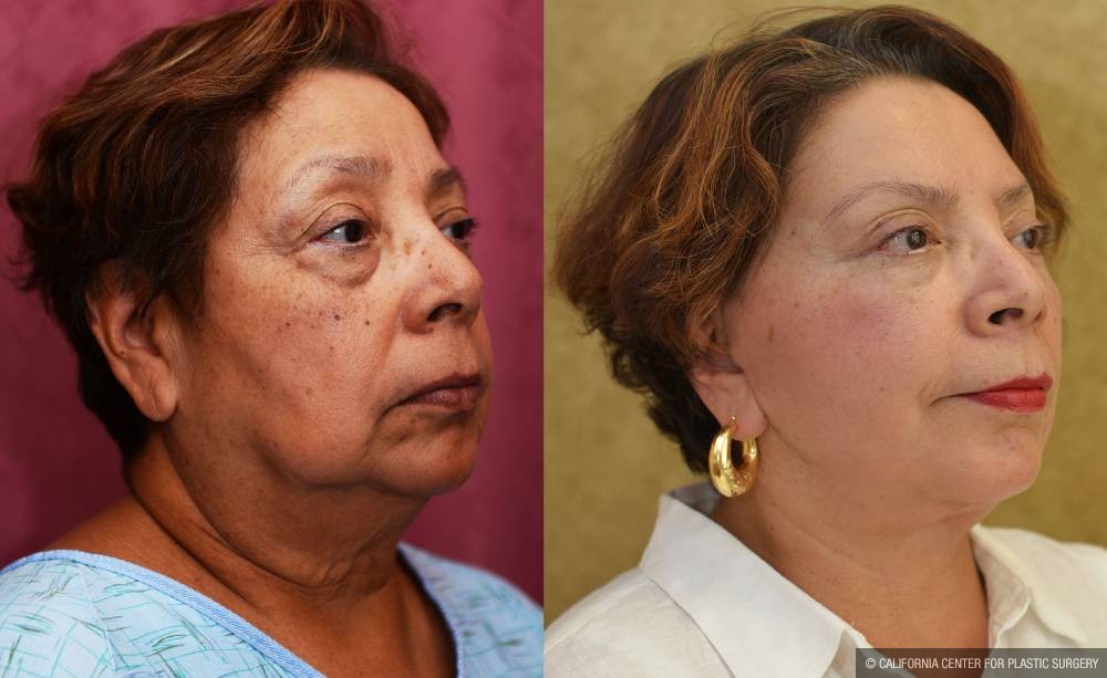 Facelift Before & After Patient #13101