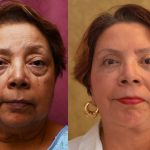 Facelift Before & After Patient #13101