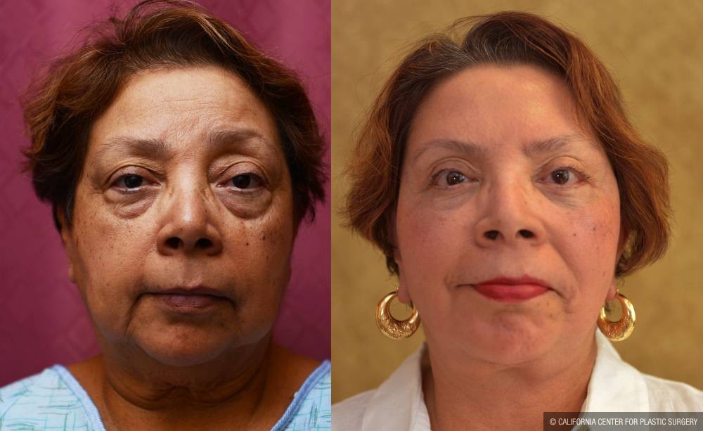 Facelift Before & After Patient #13101