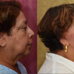 Facelift Before & After Patient #13101