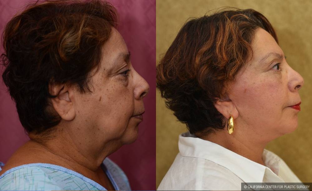 Facelift Before & After Patient #13101