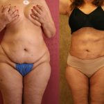 Liposuction of Buttocks Before & After Patient #13272