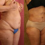Liposuction of Buttocks Before & After Patient #13272