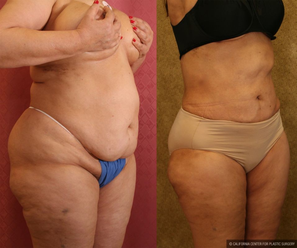 Liposuction of Buttocks Before & After Patient #13272