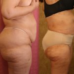 Liposuction of Buttocks Before & After Patient #13272