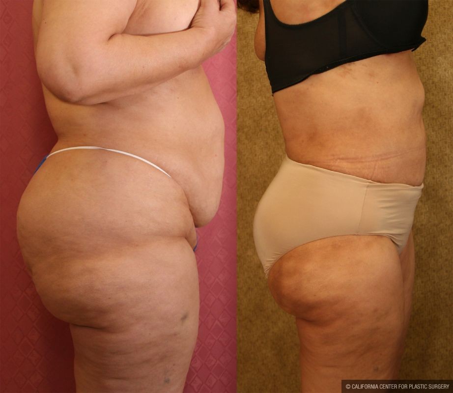 Liposuction of Buttocks Before & After Patient #13272