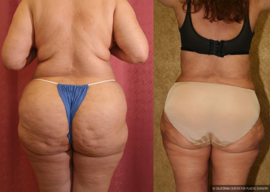 Liposuction of Buttocks Before & After Patient #13272