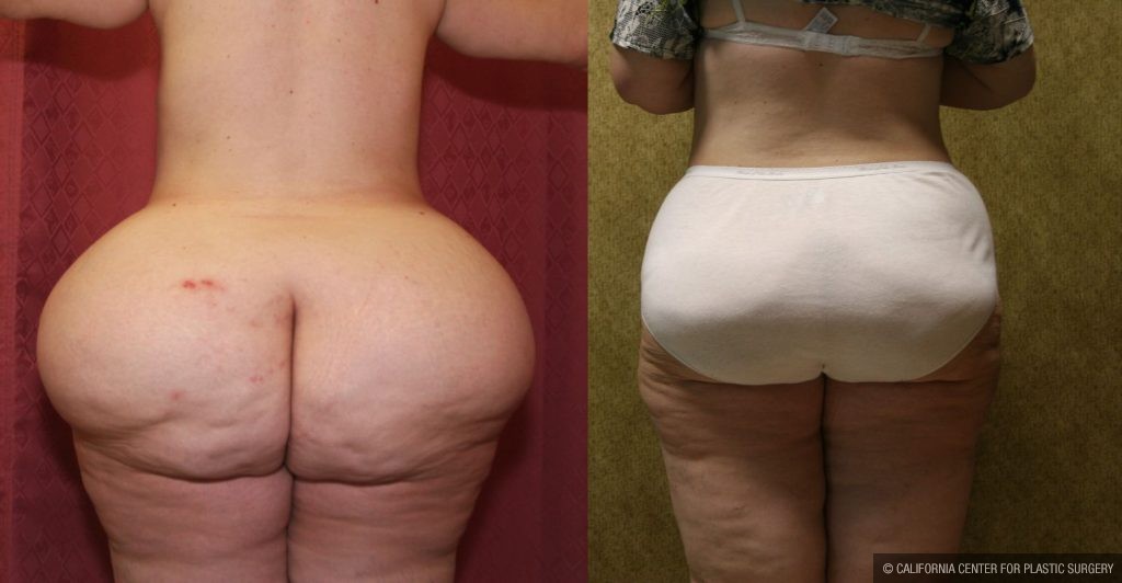 Liposuction of Buttocks Before & After Patient #13277
