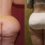 Liposuction of Buttocks Before & After Patient #13277