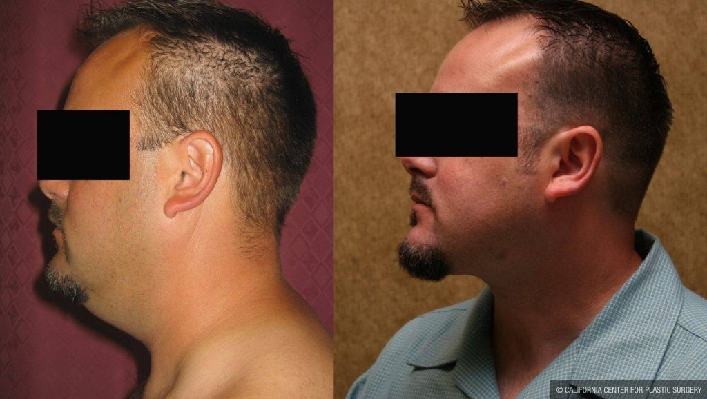 Male Neck & Face Liposuction Before & After Patient #13279