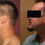 Male Neck & Face Liposuction Before & After Patient #13279