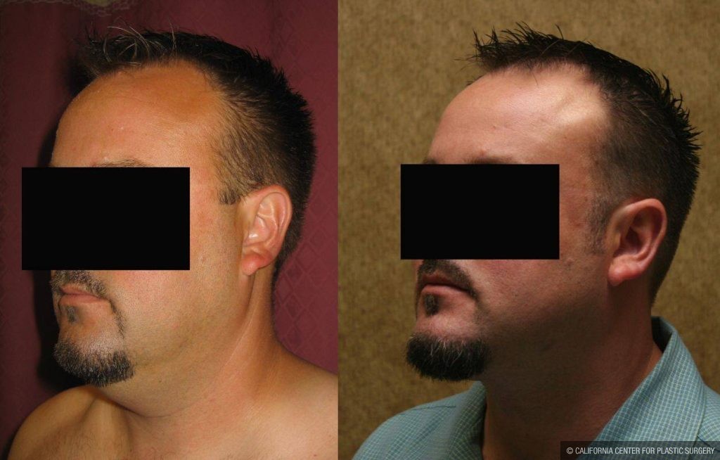 Male Neck & Face Liposuction Before & After Patient #13279