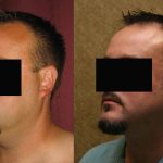 Male Neck & Face Liposuction Before & After Patient #13279