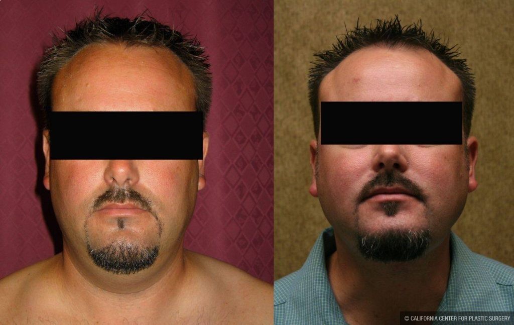 Male Neck & Face Liposuction Before & After Patient #13279