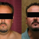 Male Neck & Face Liposuction Before & After Patient #13279