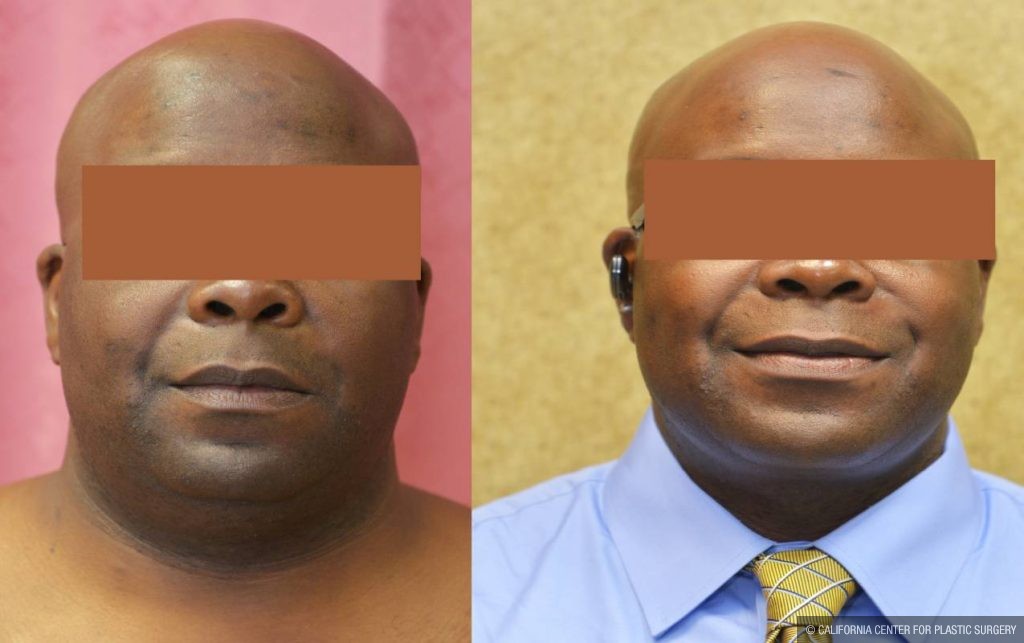 Male Neck & Face Liposuction Before & After Patient #13280